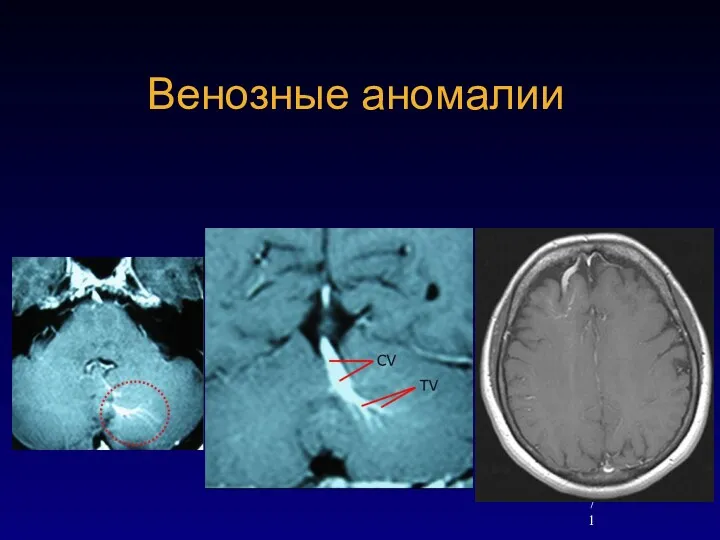 Венозные аномалии