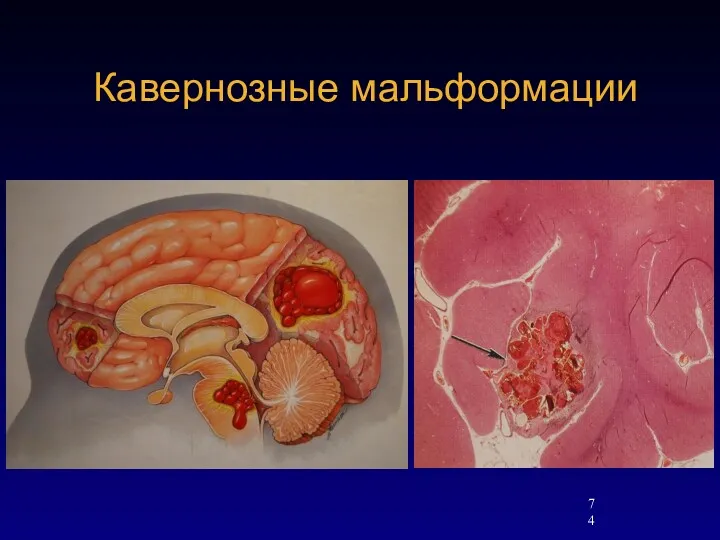 Кавернозные мальформации