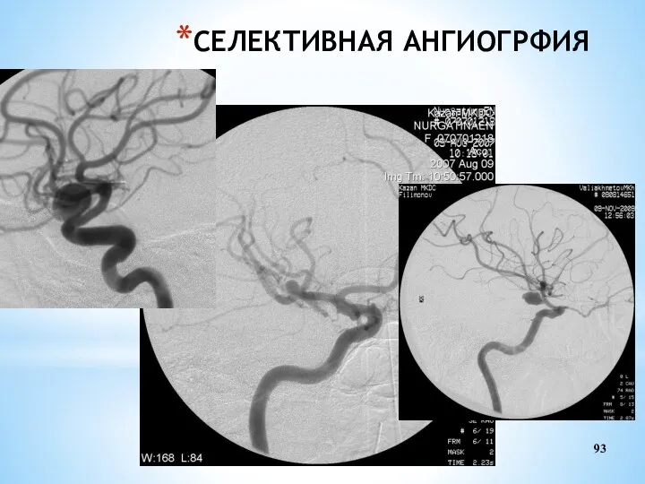 СЕЛЕКТИВНАЯ АНГИОГРФИЯ