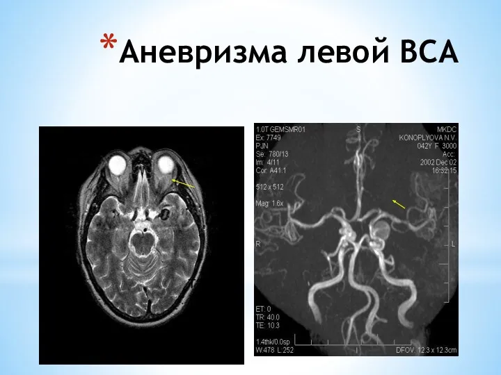 Аневризма левой ВСА Т2-ВИ