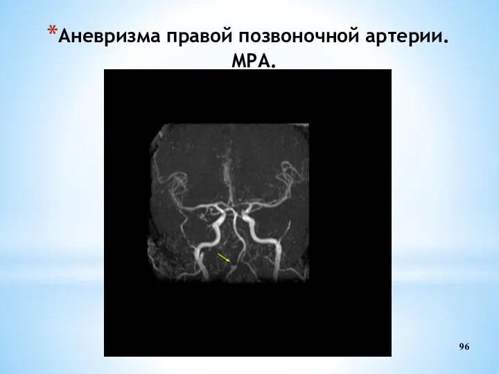Аневризма правой позвоночной артерии. МРА.