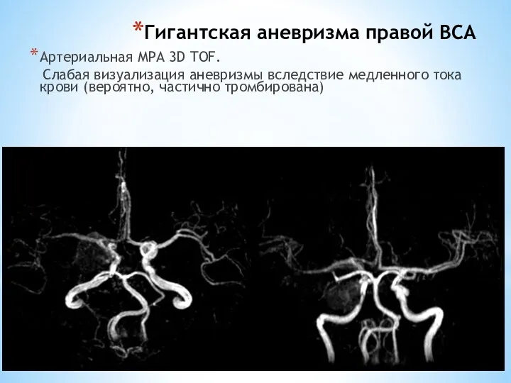 Гигантская аневризма правой ВСА Артериальная МРА 3D TOF. Слабая визуализация