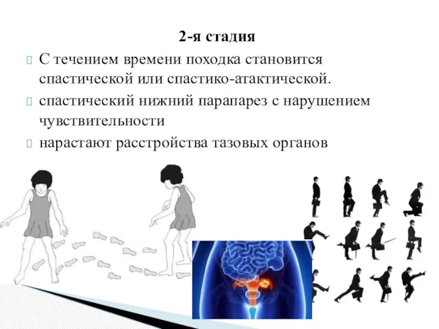 2-я стадия С течением времени походка становится спастической или спастико-атактической.