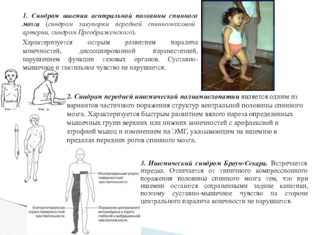 1. Синдром ишемии вентральной половины спинного мозга (синдром закупорки передней