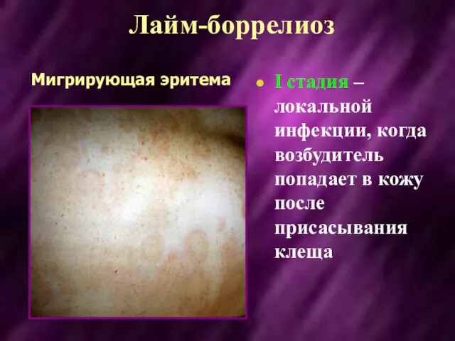 Лайм-боррелиоз I стадия – локальной инфекции, когда возбудитель попадает в кожу после присасывания клеща Мигрирующая эритема