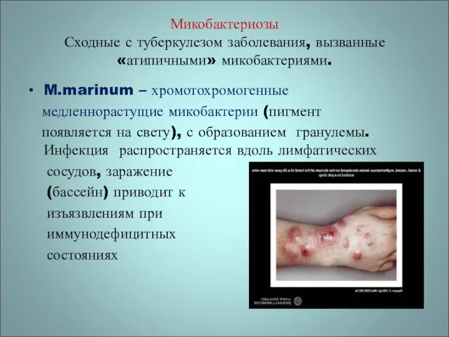 Микобактериозы Сходные с туберкулезом заболевания, вызванные «атипичными» микобактериями. M.marinum –