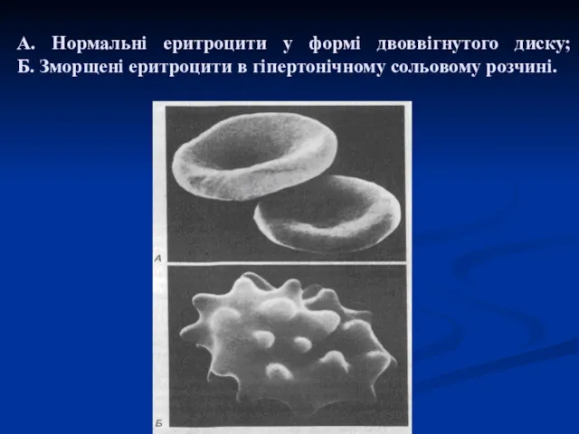 А. Нормальні еритроцити у формі двоввігнутого диску; Б. Зморщені еритроцити в гіпертонічному сольовому розчині.