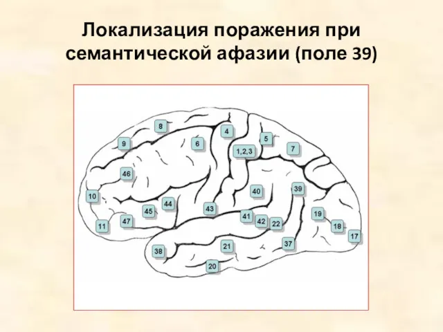 Локализация поражения при семантической афазии (поле 39)