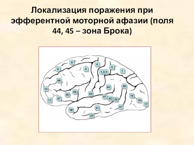 Локализация поражения при эфферентной моторной афазии (поля 44, 45 – зона Брока)