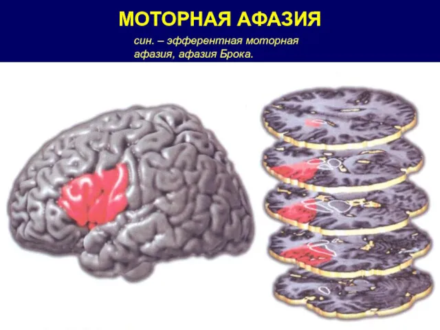 МОТОРНАЯ АФАЗИЯ син. – эфферентная моторная афазия, афазия Брока.