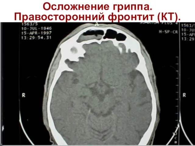 Осложнение гриппа. Правосторонний фронтит (КТ).