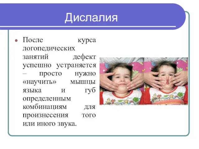 Дислалия После курса логопедических занятий дефект успешно устраняется – просто