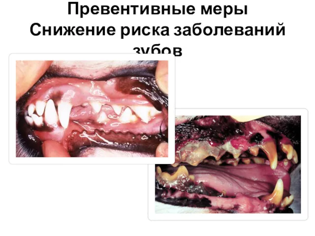Превентивные меры Снижение риска заболеваний зубов