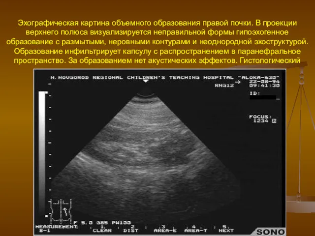 Эхографическая картина объемного образования правой почки. В проекции верхнего полюса
