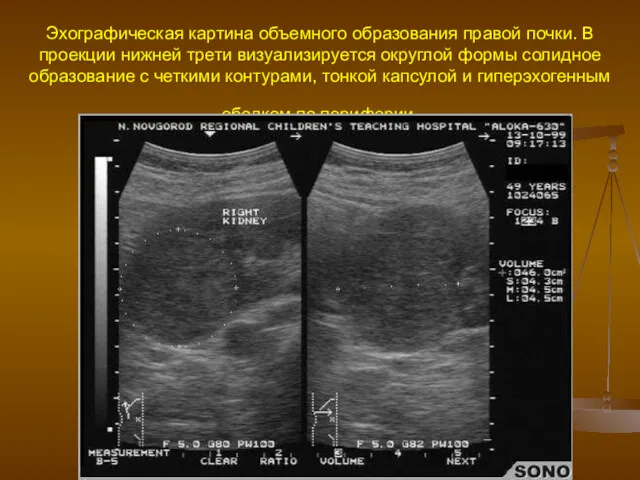 Эхографическая картина объемного образования правой почки. В проекции нижней трети