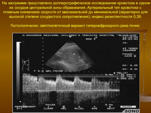 На эхограмме представлено доплерографическое исследование кровотока в одном из сосудов