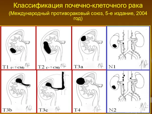 Классификация почечно-клеточного рака (Международный противораковый союз, 5-е издание, 2004 год)