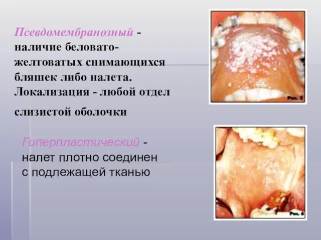 Псевдомембранозный - наличие беловато-желтоватых снимающихся бляшек либо налета. Локализация -