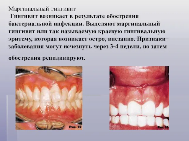 Маргинальный гингивит Гингивит возникает в результате обострения бактериальной инфекции. Выделяют