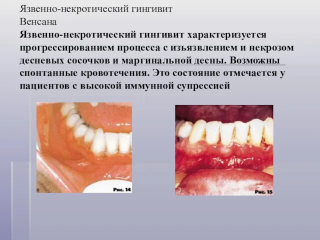 Язвенно-некротический гингивит Венсана Язвенно-некротический гингивит характеризуется прогрессированием процесса с изъязвлением