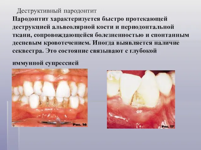 Деструктивный пародонтит Пародонтит характеризуется быстро протекающей деструкцией альвеолярной кости и