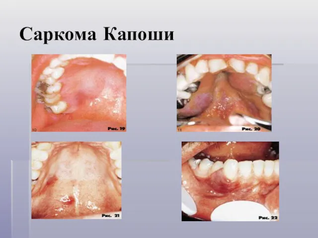 Саркома Капоши