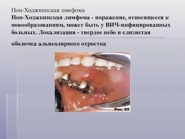 Нон-Ходжкинская лимфома Нон-Ходжкинская лимфома - поражение, относящееся к новообразованиям, может