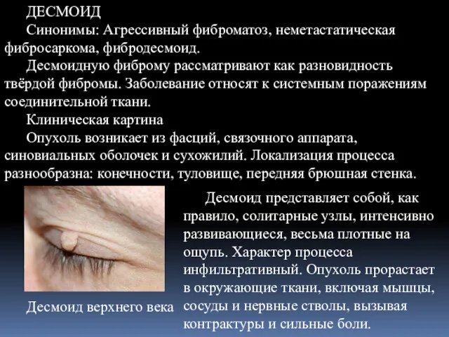 ДЕСМОИД Синонимы: Агрессивный фиброматоз, неметастатическая фибросаркома, фибродесмоид. Десмоидную фиброму рассматривают