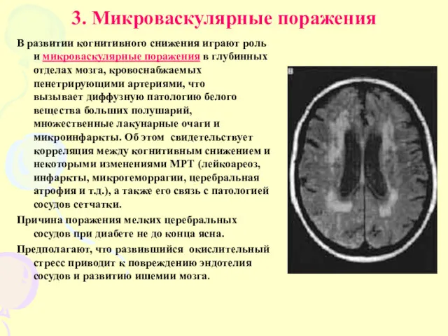 3. Микроваскулярные поражения В развитии когнитивного снижения играют роль и