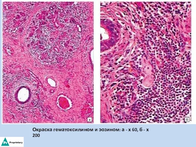 Окраска гематоксилином и эозином: а - х 60, б - х 200