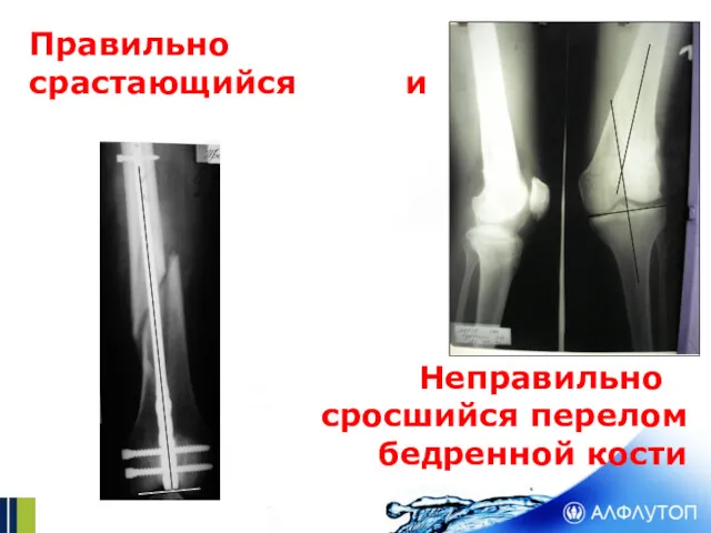 Правильно срастающийся и Неправильно сросшийся перелом бедренной кости