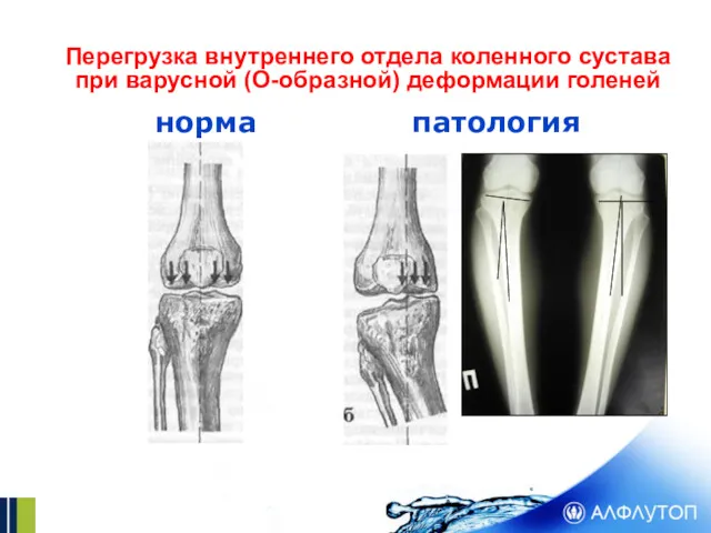 Перегрузка внутреннего отдела коленного сустава при варусной (О-образной) деформации голеней норма патология