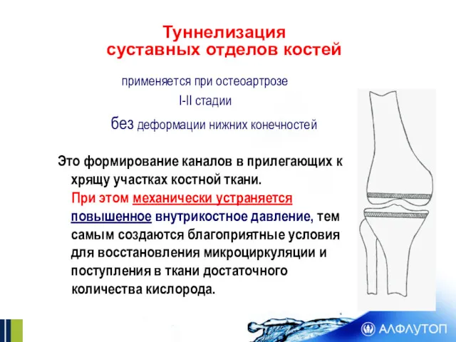 Туннелизация суставных отделов костей применяется при остеоартрозе I-II стадии без