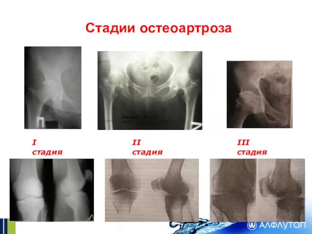 Стадии остеоартроза I стадия II стадия III стадия