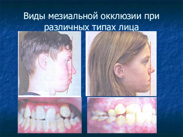 Виды мезиальной окклюзии при различных типах лица