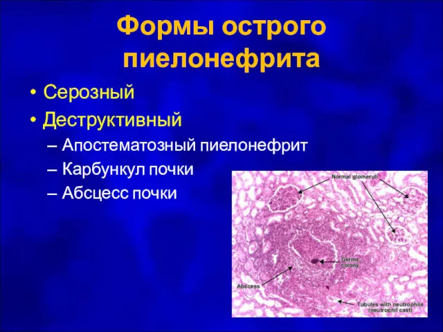 Формы острого пиелонефрита Серозный Деструктивный Апостематозный пиелонефрит Карбункул почки Абсцесс почки