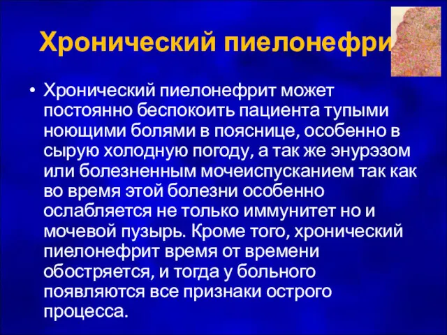 Хронический пиелонефрит Хронический пиелонефрит может постоянно беспокоить пациента тупыми ноющими