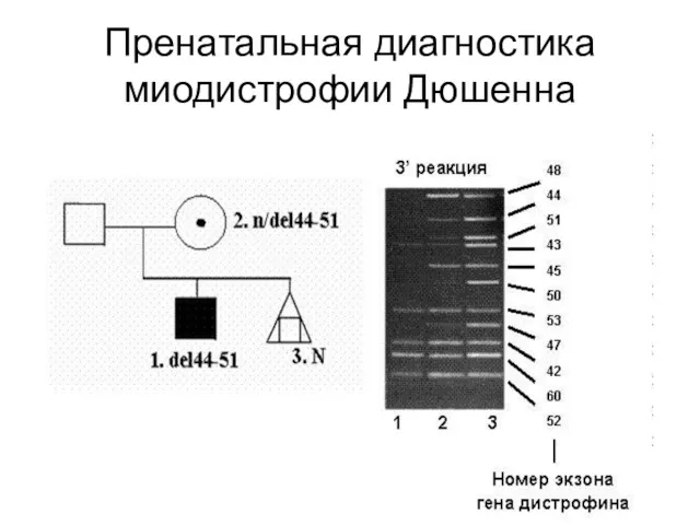 Пренатальная диагностика миодистрофии Дюшенна