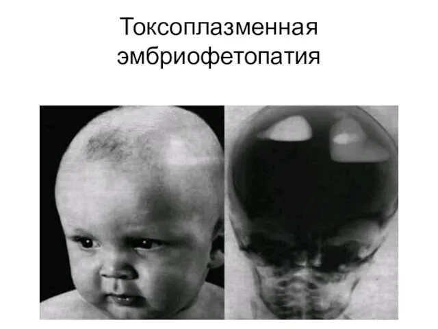 Токсоплазменная эмбриофетопатия