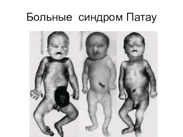 Больные синдром Патау