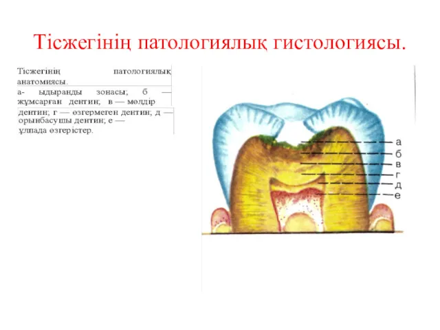 Тісжегінің патологиялық гистологиясы.