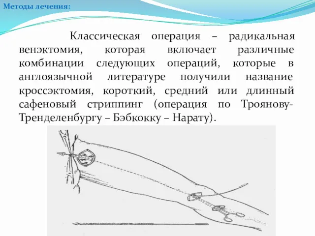 Классическая операция – радикальная венэктомия, которая включает различные комбинации следующих