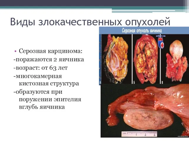 Виды злокачественных опухолей Серозная карцинома: -поражаются 2 яичника -возраст: от