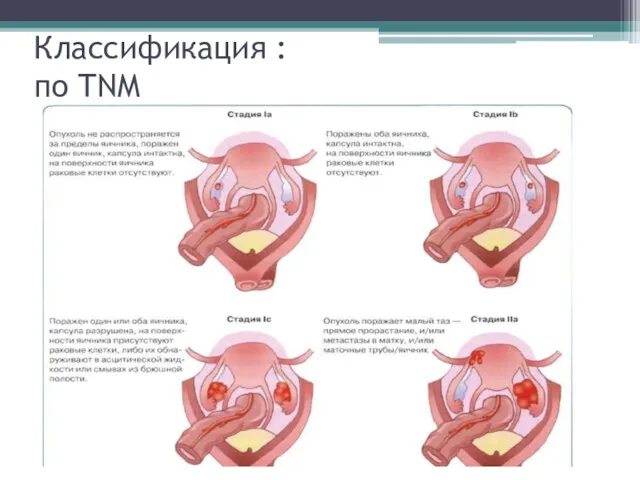 Классификация : по TNM