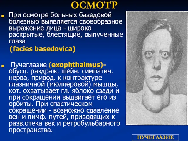 ОСМОТР При осмотре больных базедовой болезнью выявляется своеобразное выражение лица