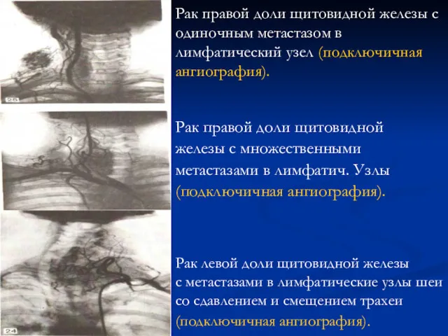 Рак левой доли щитовидной железы с метастазами в лимфатические узлы