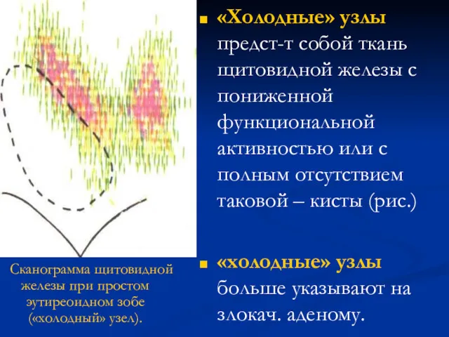 «Холодные» узлы предст-т собой ткань щитовидной железы с пониженной функциональной