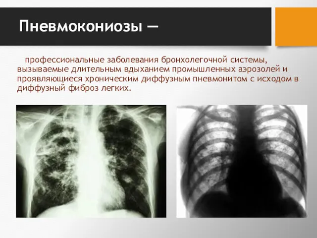 Пневмокониозы — профессиональные заболевания бронхолегоч­ной системы, вызываемые длительным вдыханием промышленных