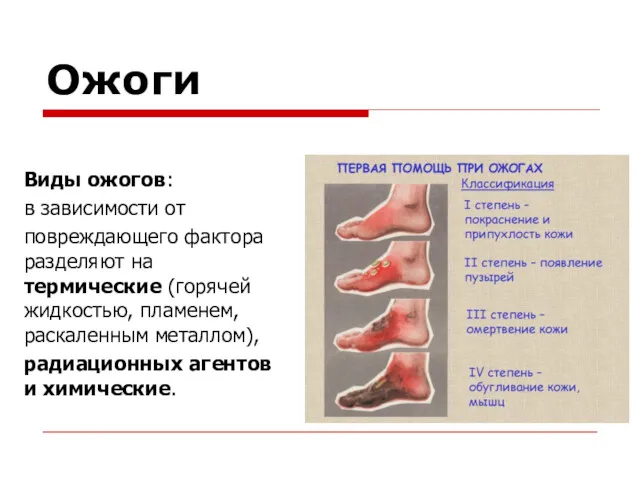 Ожоги Виды ожогов: в зависимости от повреждающего фактора разделяют на термические (горячей жидкостью,