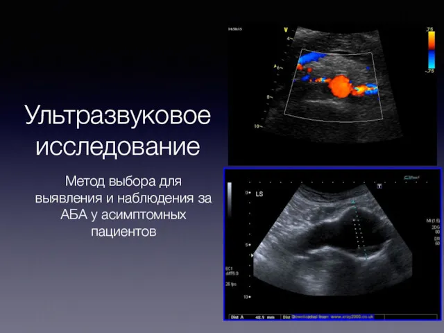 Ультразвуковое исследование Метод выбора для выявления и наблюдения за АБА у асимптомных пациентов